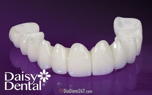 Báo giá bọc răng sứ 2022 - Bọc răng sứ Nha khoa DAISY 